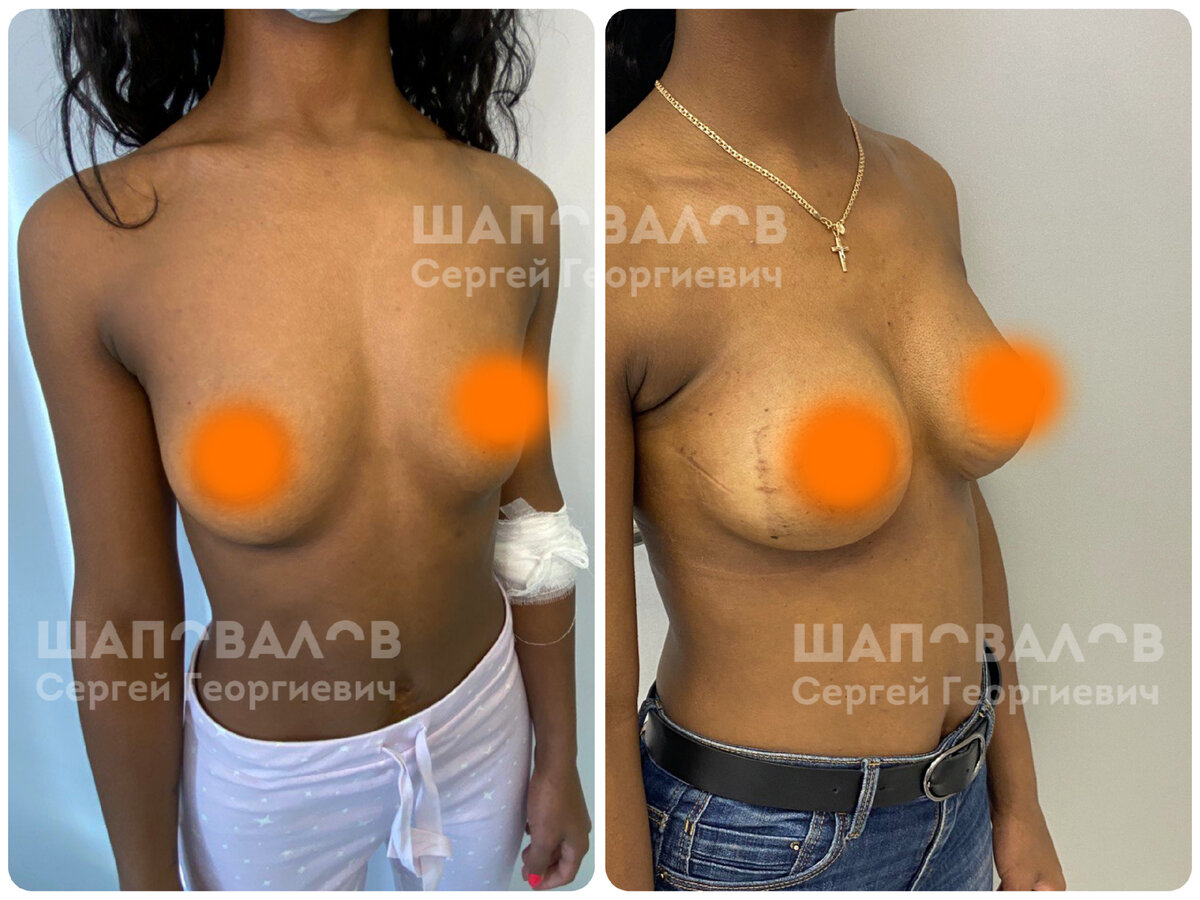 фото «ДО» и фото «ПОСЛЕ» пластики