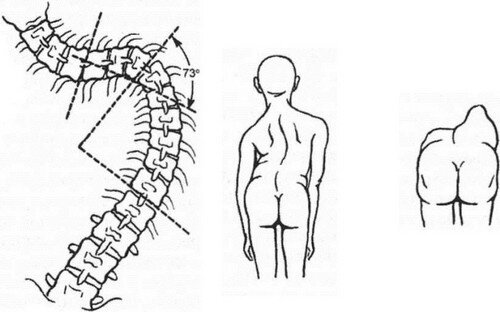 4 степень сколиоза. Искривление позвоночника четвёртый степени. Сколиоз позвоночника градусы. Сколиоз 4 степени рентген операция. Сколиоз угол искривления 17 градусов.