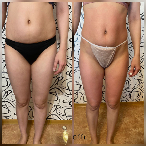 Лимфодренажный массаж. Клиника косметологии и пластической Красноярск