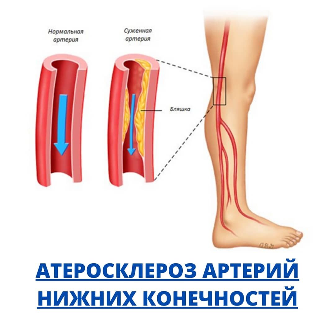 Стол при атеросклерозе сосудов нижних конечностей