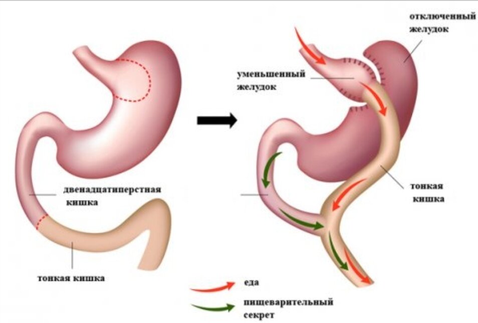 Шунтирование 