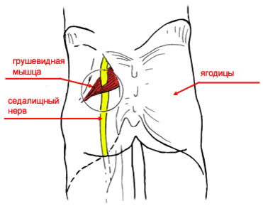 Ягодичная мышца и седалищный нерв. Грушевидная мышца ягодицы. Грушевиднгая мышца ягодицу. Болит грушевидная мышца в ягодице.