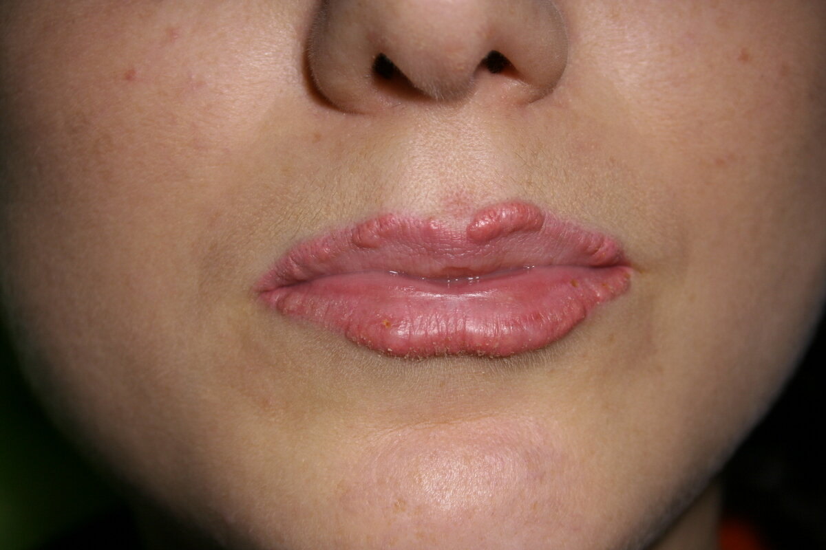 Очаги гранулемы красной каймы губ после татуажа губ