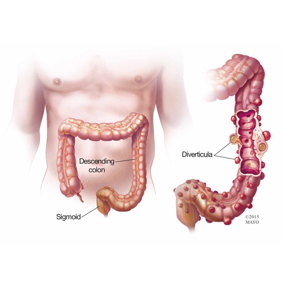 Дивертикулез сигмовидной кишки симптомы и лечение. Дивертикулёз толстой кишки. Что такое дивертикулит Толстого кишечника. Дивертикулез ободочной кишки. Дивертикул Меккеля от илеоцекального.