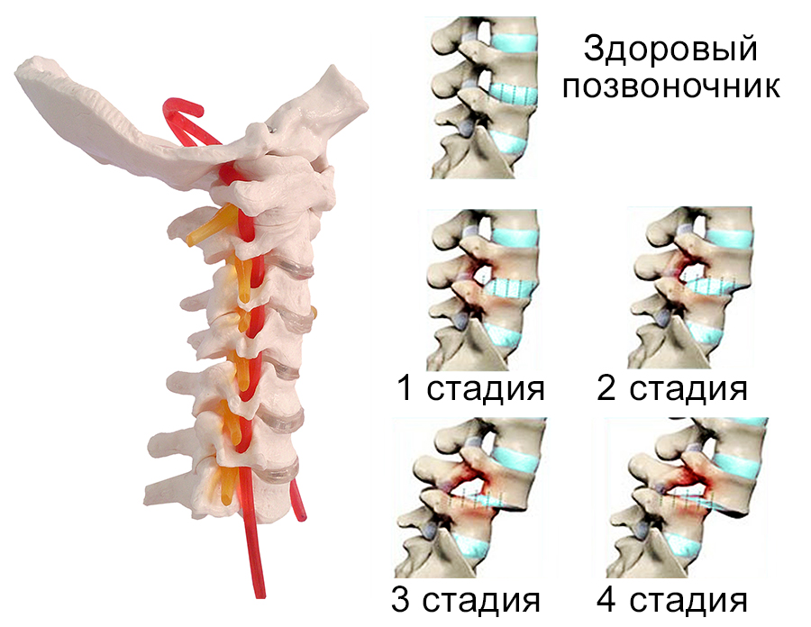 Что делают при смещение. Смещение 5 позвонка шейного отдела. Смещение 4-5 шейных позвонков. Травматический спондилолистез II шейного позвонка..