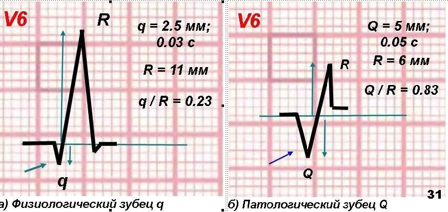 Зубец q на экг avl. Q в 3 отведении на экг. Патологический q в iii. Экг острый инфаркт миокарда с подъемом st. Патологический зубец q на экг при инфаркте.