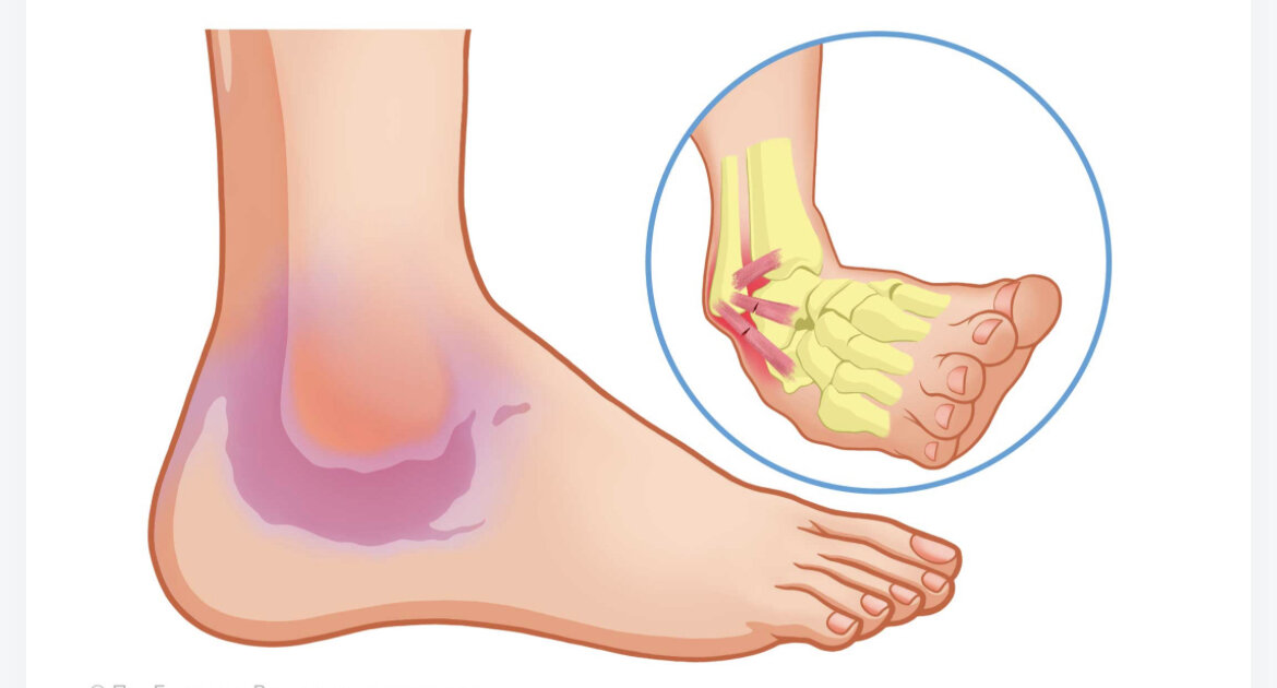 Растяжение связок голеностопного сустава лечение мазь. Порванные связки голеностопа. Растяжение стопы симптомы. Растяжение связок голеностопа. Разрыв связок голеностопного сустава.