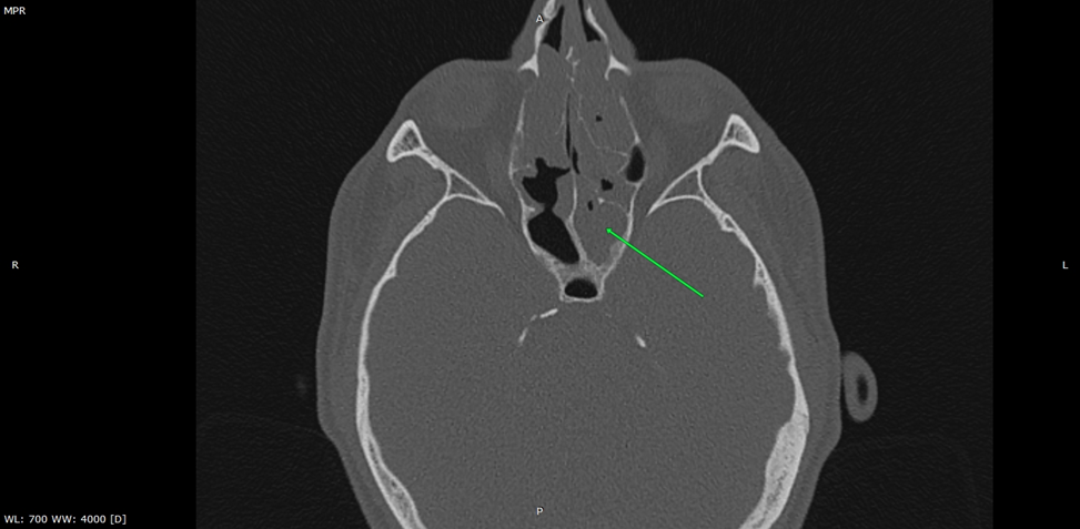 Тотальное заполнение клиновидной  пазухи содержимым на компьютерной томограмме придаточных пазух носа.
