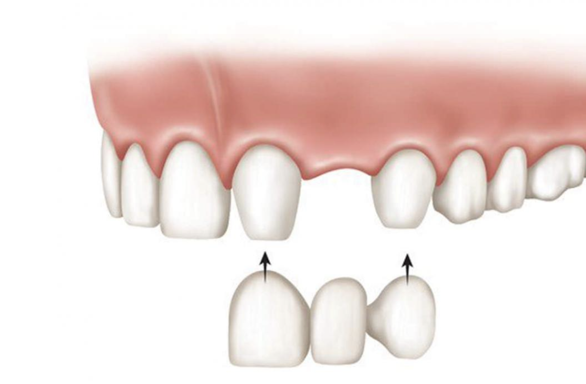 Мостовидный протез на 2 зуба передних. Мостовидный протез на 3 зуба. Мостовидный протез на 4 зуба передних верхних. Несъемный мостовидный протез. 3 зуба установить