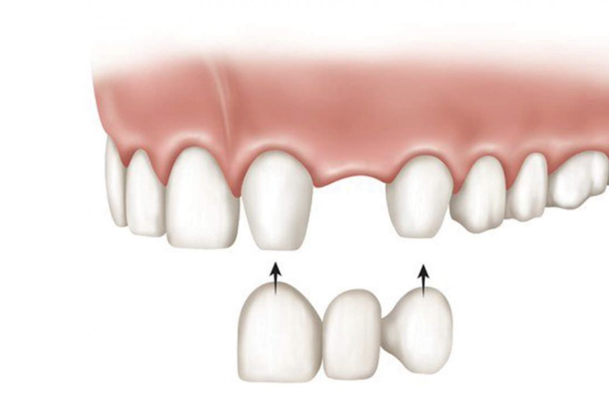 Мост между зубами. Мостовидный протез из 3 коронок. Мостовидный протез при отсутствии 3 зубов. Мостовидный протез на 3 зуба.