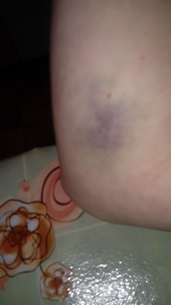 Это тот самый синяк