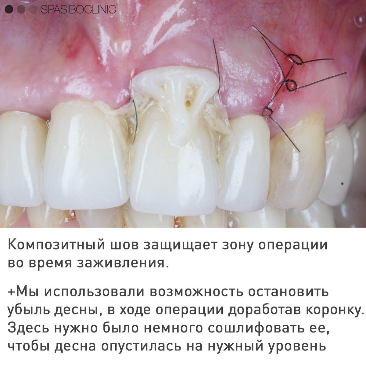 ПЕРЕДНИЙ ЗУБ: ВОСПАЛЕНИЕ КОРНЯ | Спасибо.Клиник | Дзен