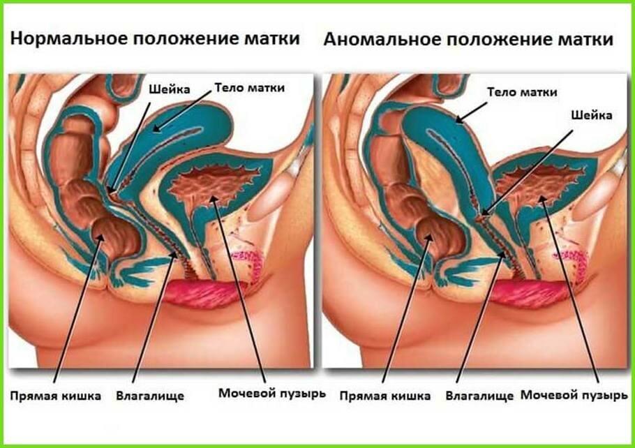 Отклонение матки кзади (ретрофлексия) | Как забеременеть - позы для зачатия