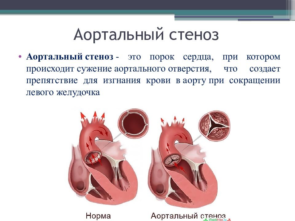 Аортальный стеноз - диагностика, причины и лечение