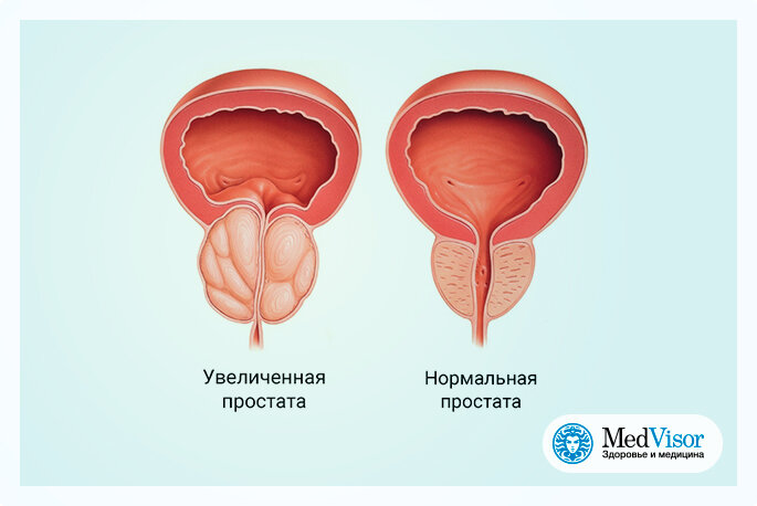 Боль в яичках у мужчин