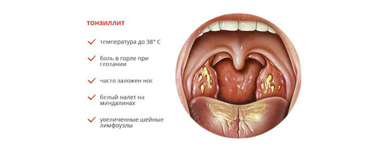 Как выглядит больное горло?