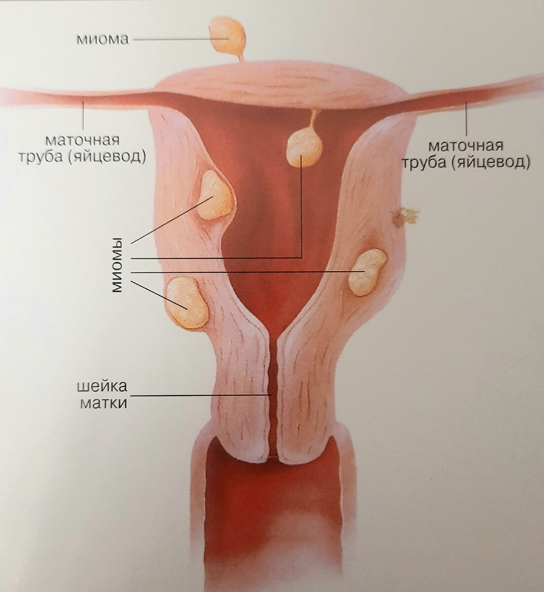 Чаще всего миомы развиваются в матке. Они могут быть разной величины и расти в любых местах. 
