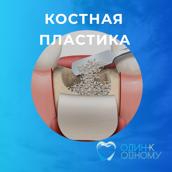 Что такое костная пластика / Рассказывает хирург платной стоматологии «Один к Одному» в Перми