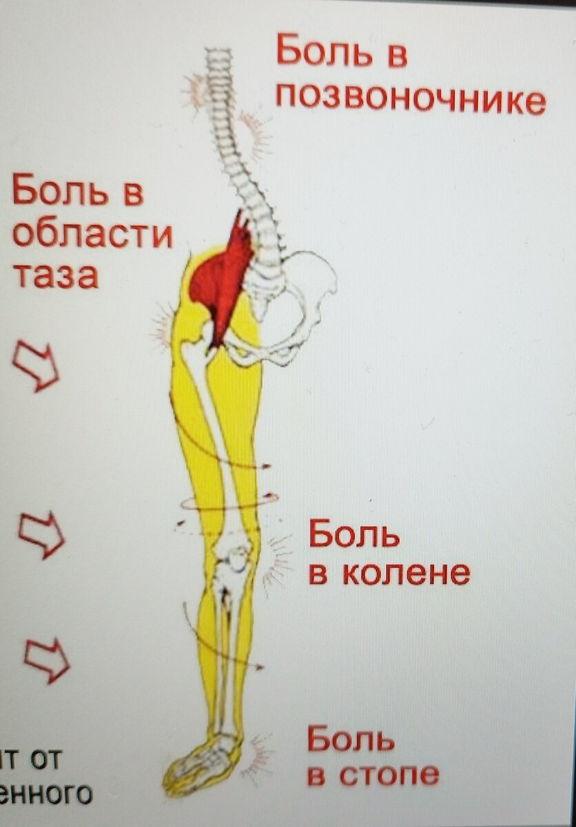 Артроз 3 и 4 степени. Стоит ли делать операцию? | Реабилитация ONLINE | Дзен