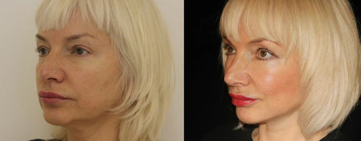 Подтяжка шеи (платизмопластика) фото до и после. Фото с сайта Д.Р. Гришкяна. Имеются противопоказания, требуется консультация специалиста