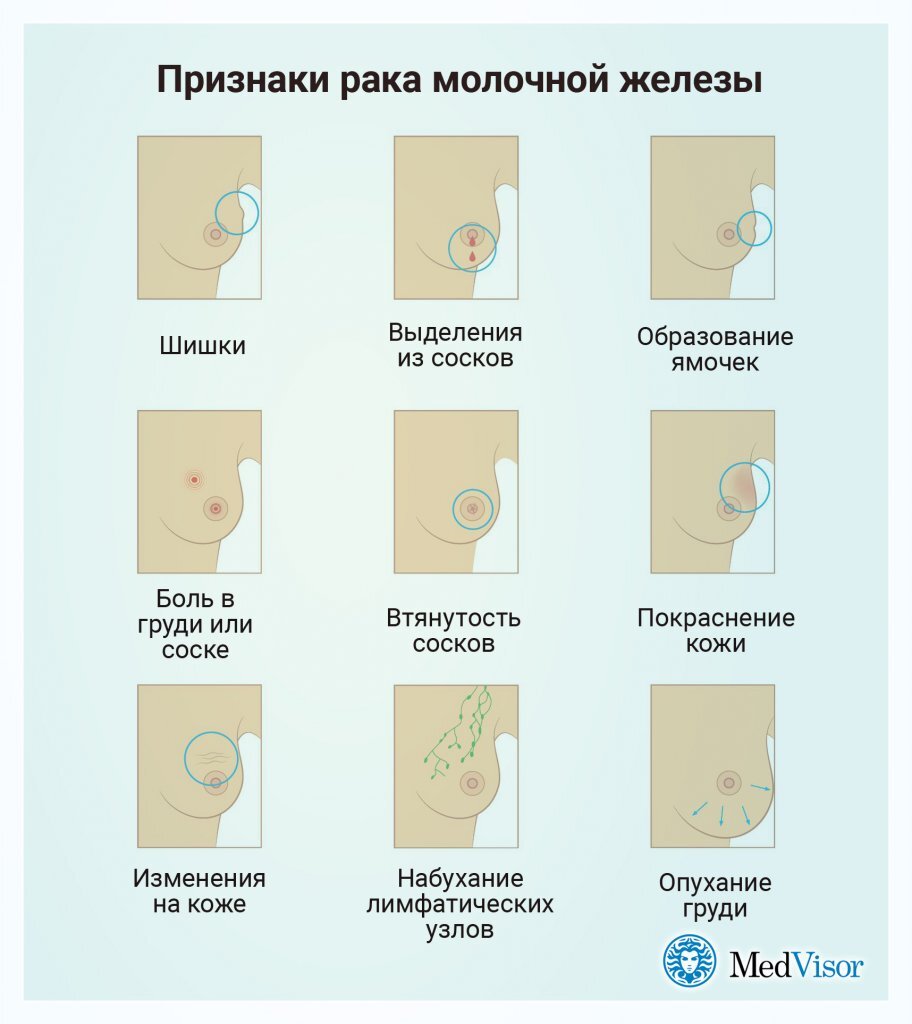 8 нетипичных признаков рака груди | medvisor.ru | Дзен