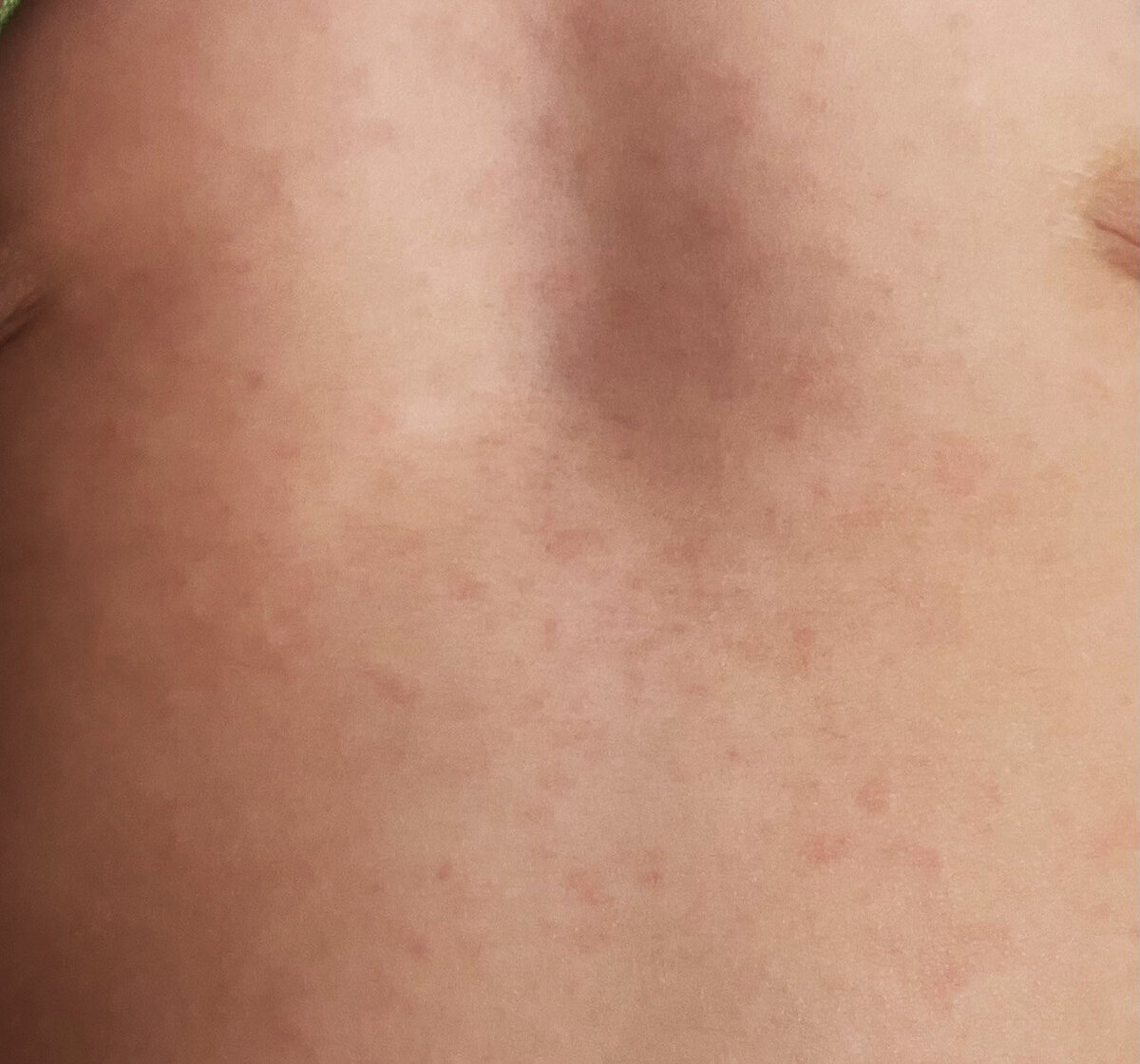 Так сыпь выглядела на второй день. Позже некоторые пятнышки стали сливаться друг с другом