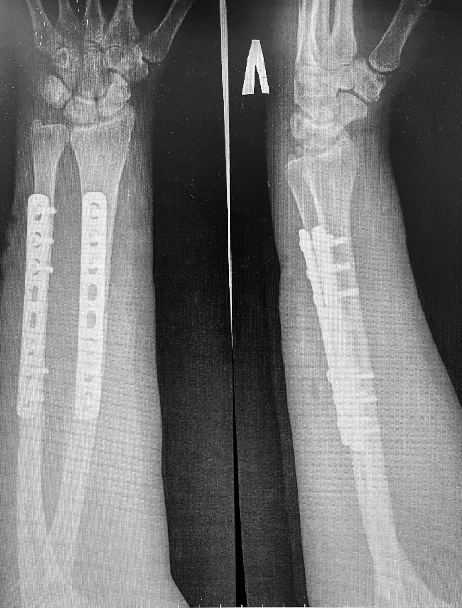 На рентгенограмме состояние после МОС, стояние отломков удовлетворительное
