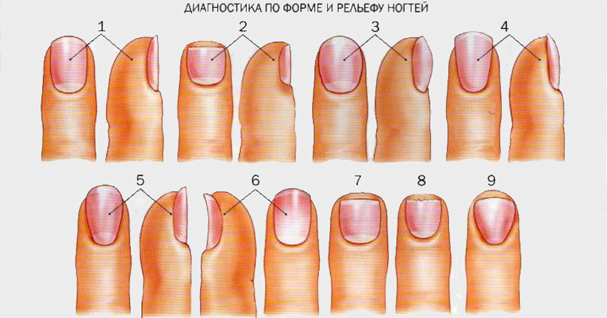 Деформации и дистрофии ногтей