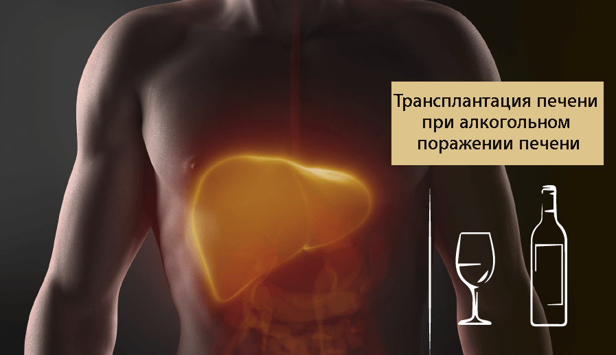 Трансплантация печени. Алкогольное поражение печени. Цирроз печени и алкоголизм. Цирроз печени трансплантация печени. Трансплантация печени цирроз.