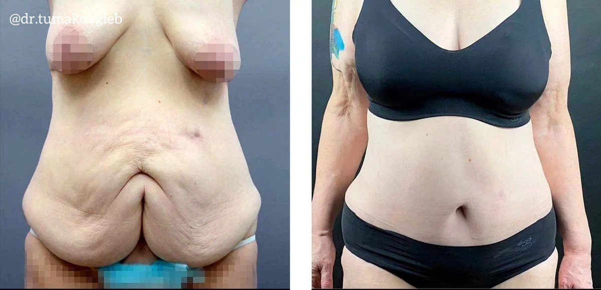 Результат абдоминопластики и подтяжки груди после бариатрической операции и массивного похудения.