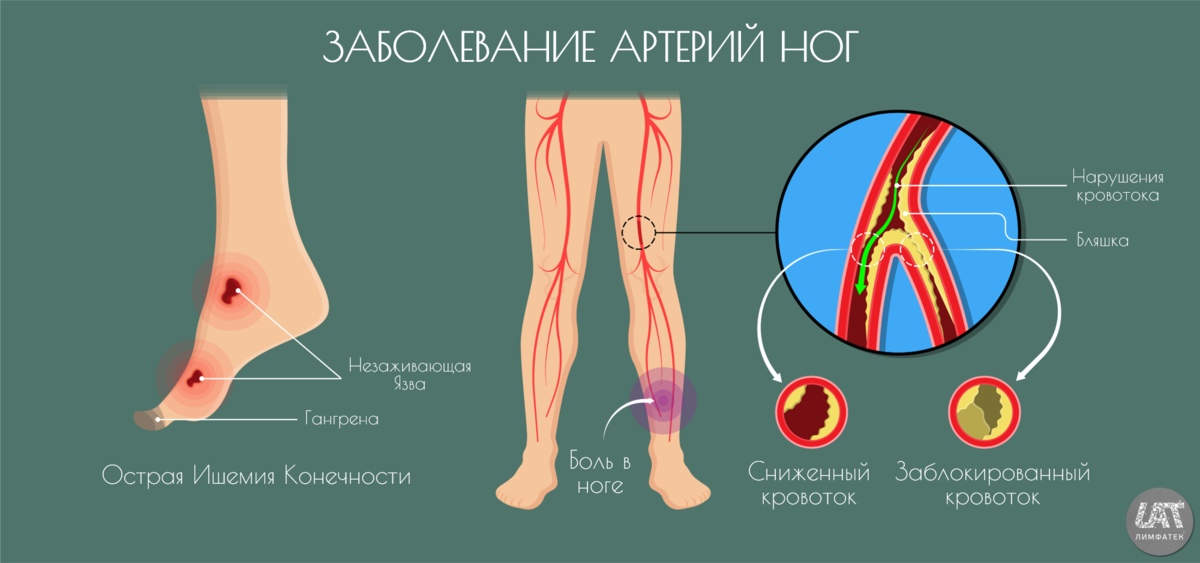 Как избавиться от холестериновых бляшек