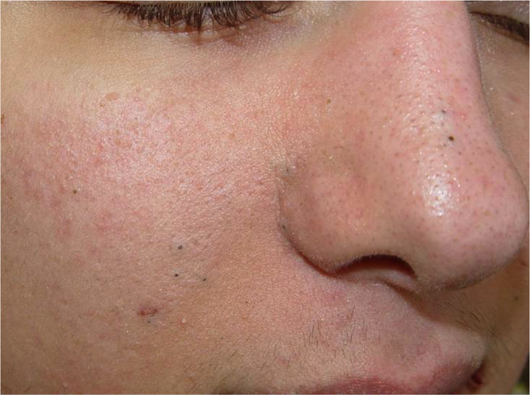 Чистка подбородка. Лицо до и после гиалуроновой кислоты. Лицо и шея девушки. Тусклая кожа. Чистая кожа эстетика.