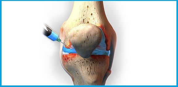 Инъекции кортизона при артрите коленного сустава