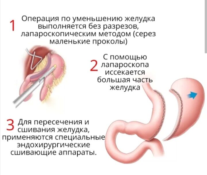 Удаление желудка. Операция по уменьшению желудка. Операция по частичному удалению желудка. Бариатрическая операция резекция желудка. Операция резекция желудка для похудения.