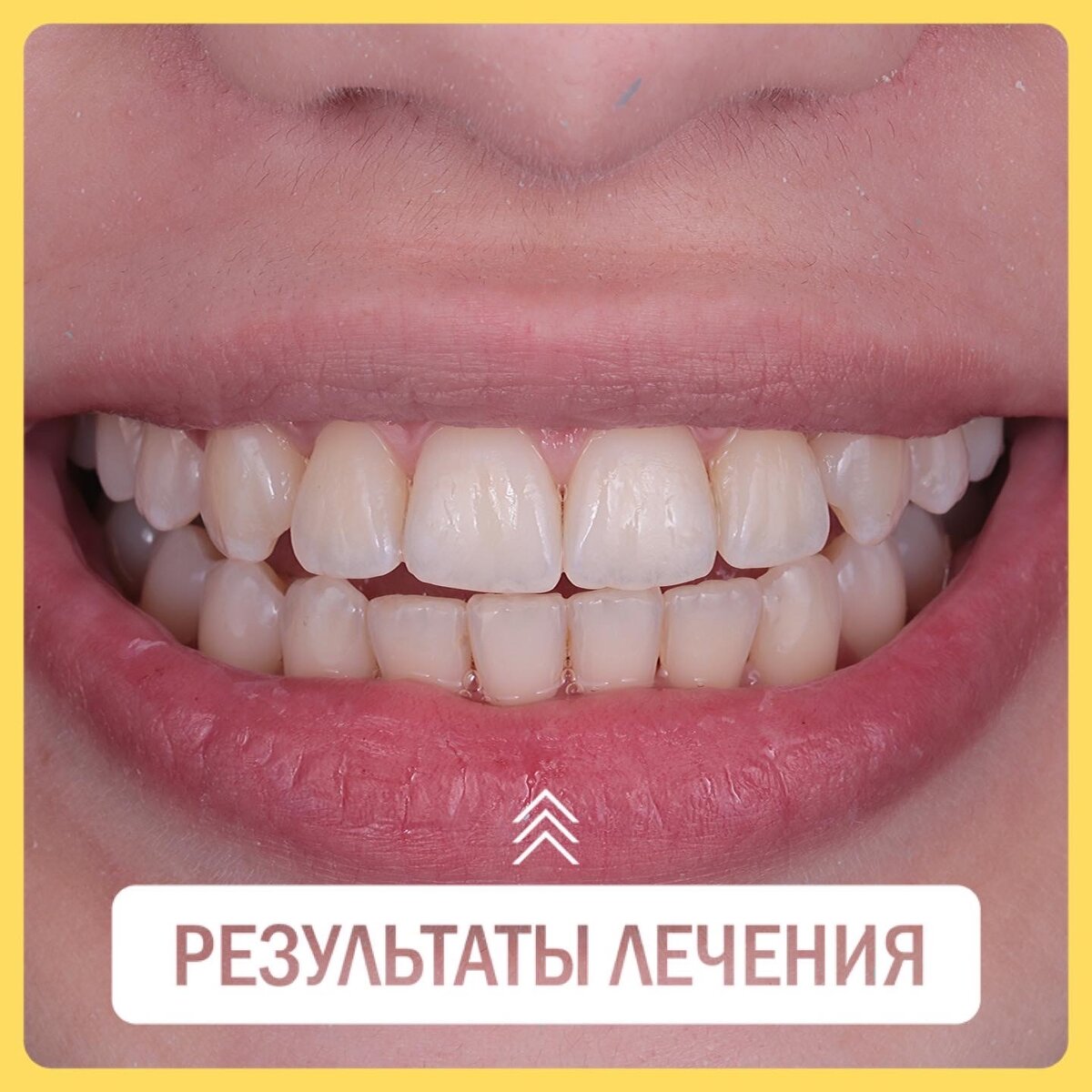 Так выглядит результат ортодонтического лечения спустя  1 год и 4 месяца с начала лечения
