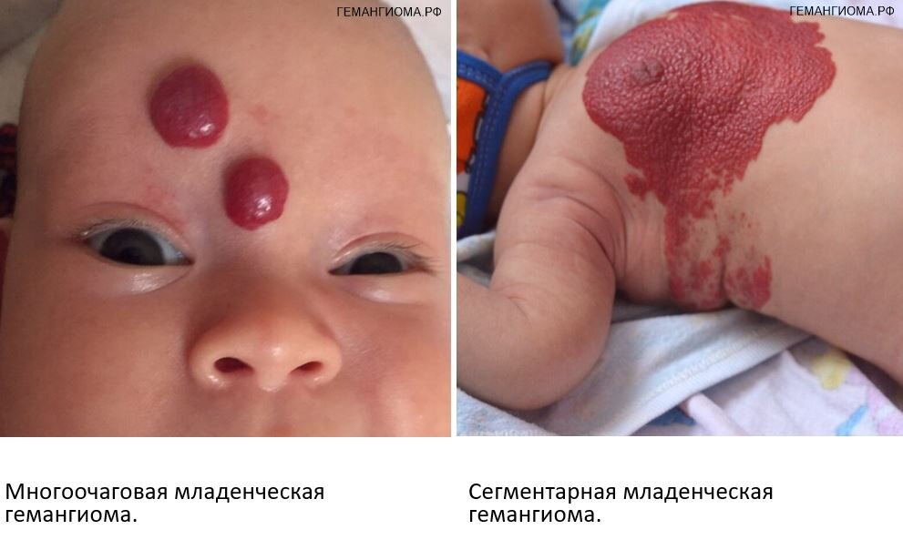 Клинический материал Центра сосудистой патологии "Гемангиома" 