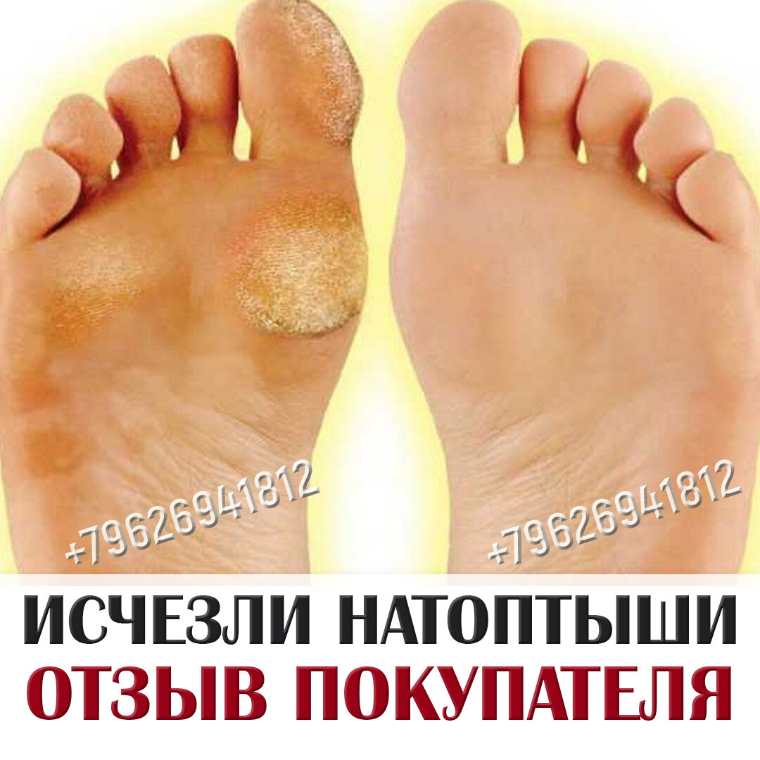 Как выглядит мозоль на ноге