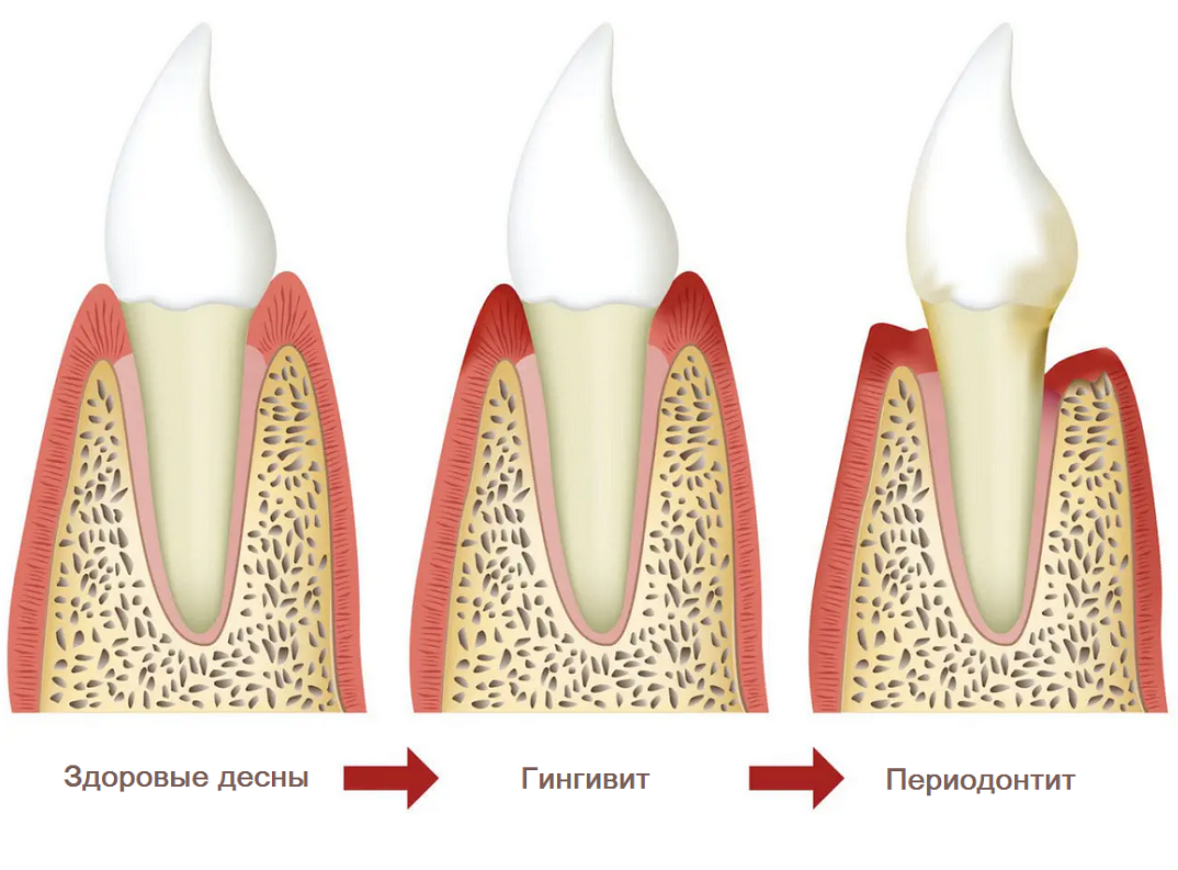Виды воспаления десен. Пародонтит периодонтит пародонтоз. Болезни пародонта гингивит пародонтит пародонтоз. Здоровый зуб гингивит пародонтит. Здоровая Десна гингивит пародонтит пародонтоз.