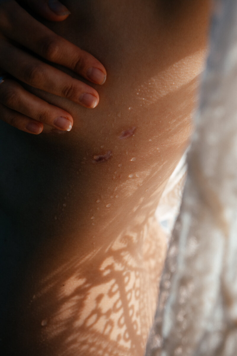 Следы от дренажей. 