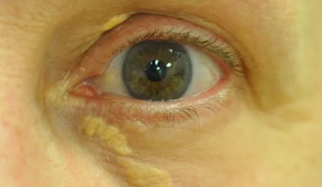 Ксантелазма век Фото взято из открытых источников