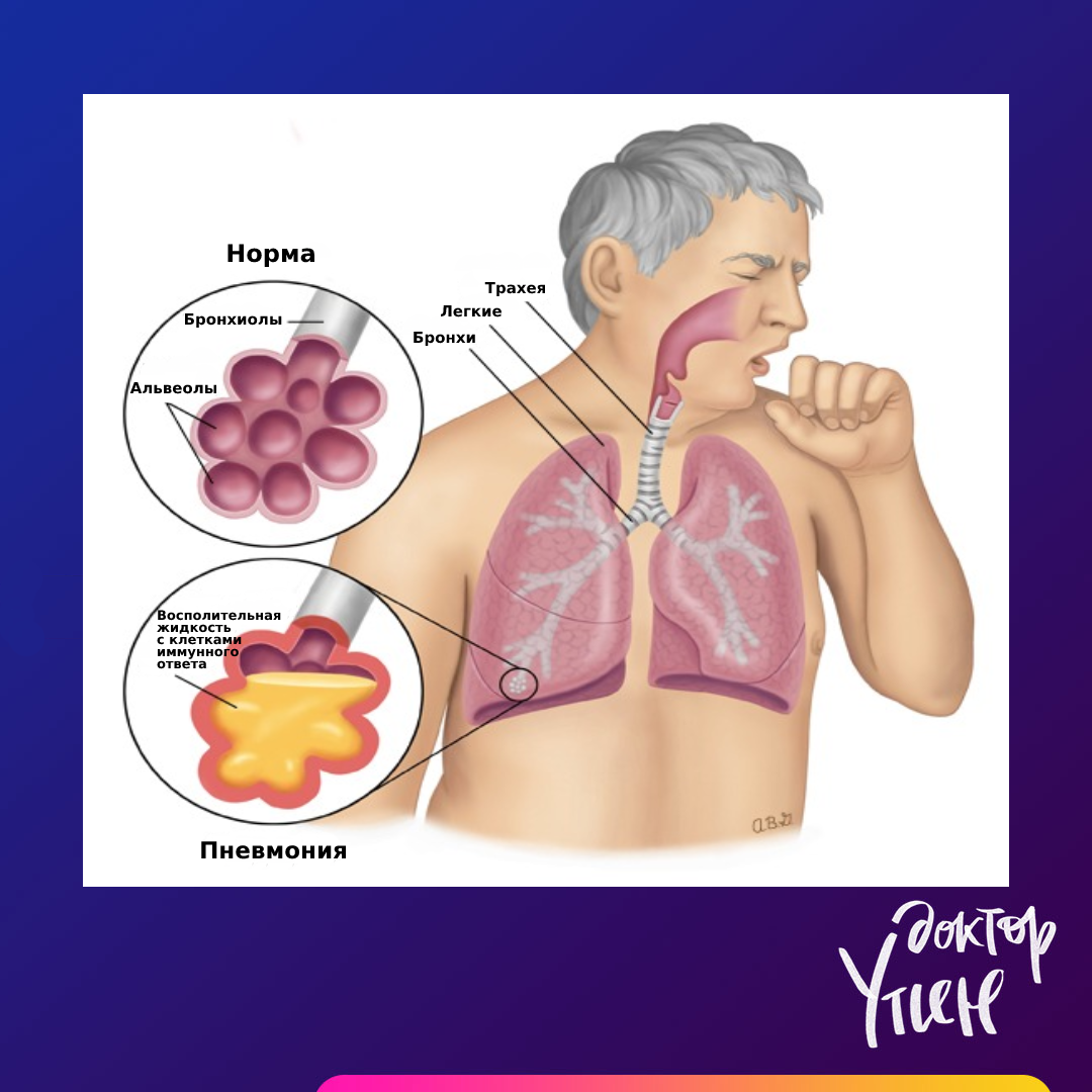 Как лечить пневмонию? Советы врача | Доктор Утин, кардиопоэт | Дзен