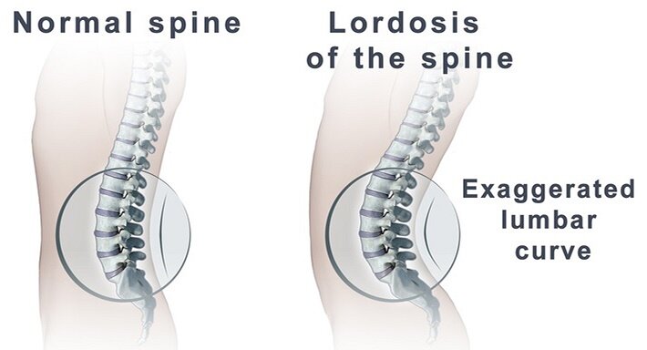 Нормальный позвоночник (слева) и гиперлордоз (справа) 