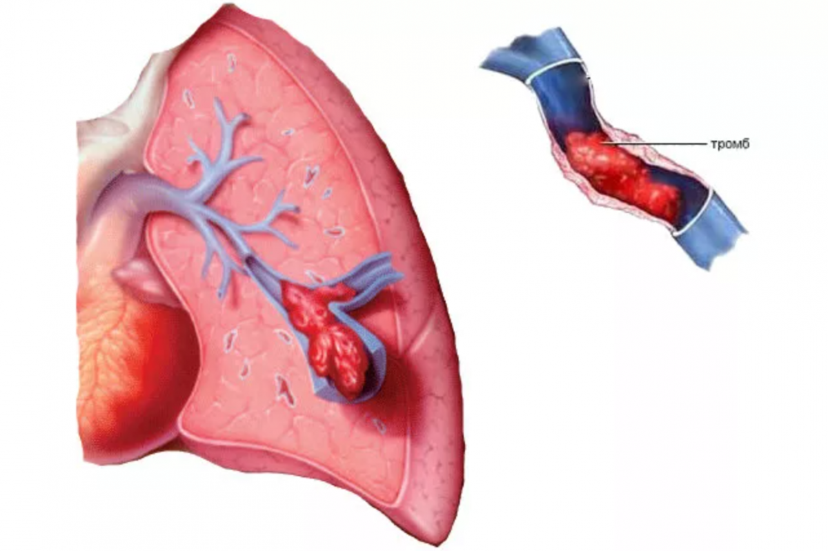 Тромб в легких. Тромбоэмболия легочной артерии. Тромбоэмболия ветвей легочной артерии. Тромбоалия лёгочной артерии. Тромболегочная эмболия.