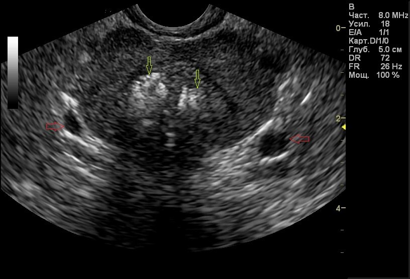 Хронический простатит узи картина