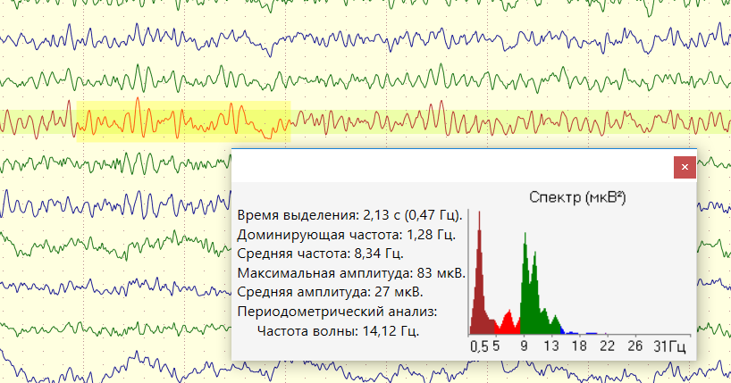 Электроэнцефалография (ЭЭГ)