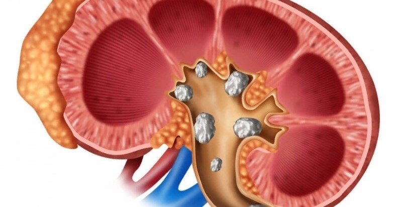 Камни в почках