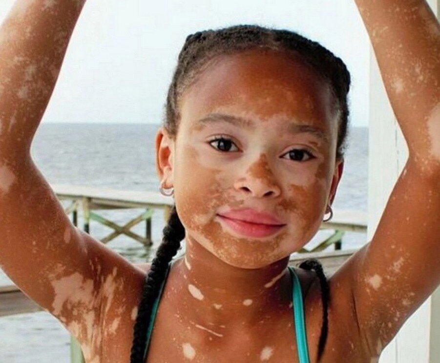 Сегментированное витилиго