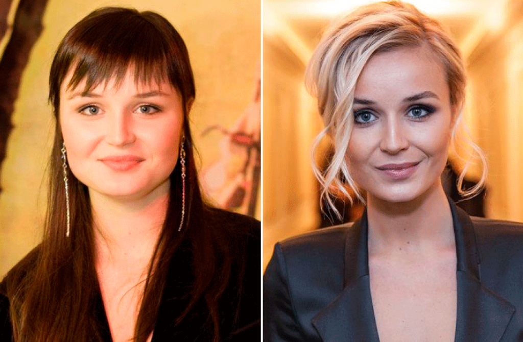 Полина Гагарина  до и после удаления комков Биша