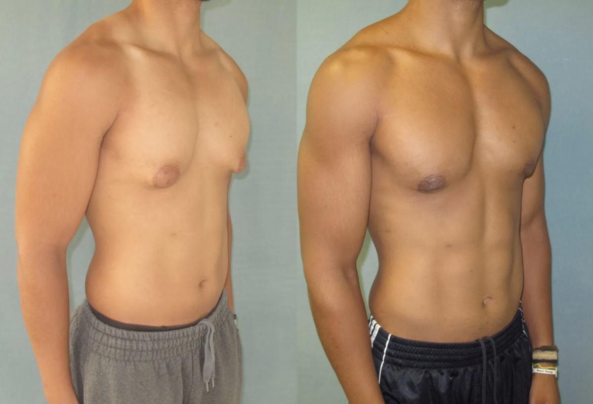удаления жира из груди у мужчин фото 114