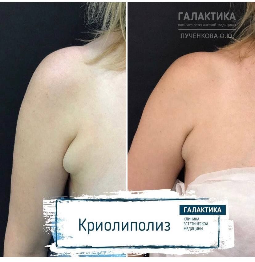 Результат работы Олеси Юрьевны Лученковой - врача-косметолога, дерматолога Клиники "Галактика"